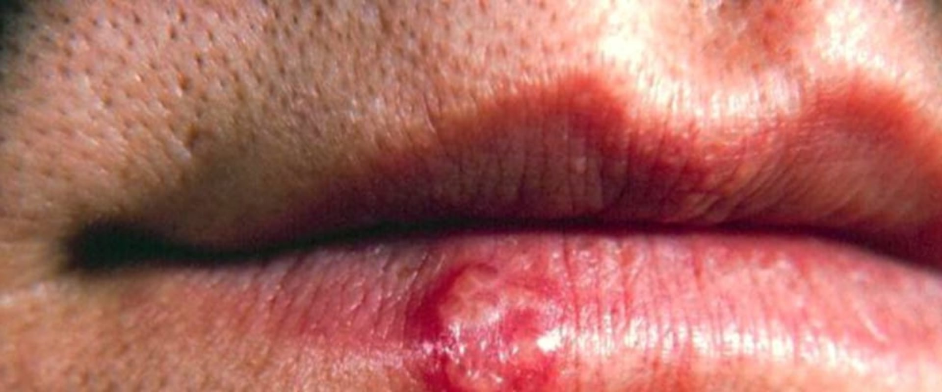 Herpes Simplex Virus (HSV): Everything You Need to Know