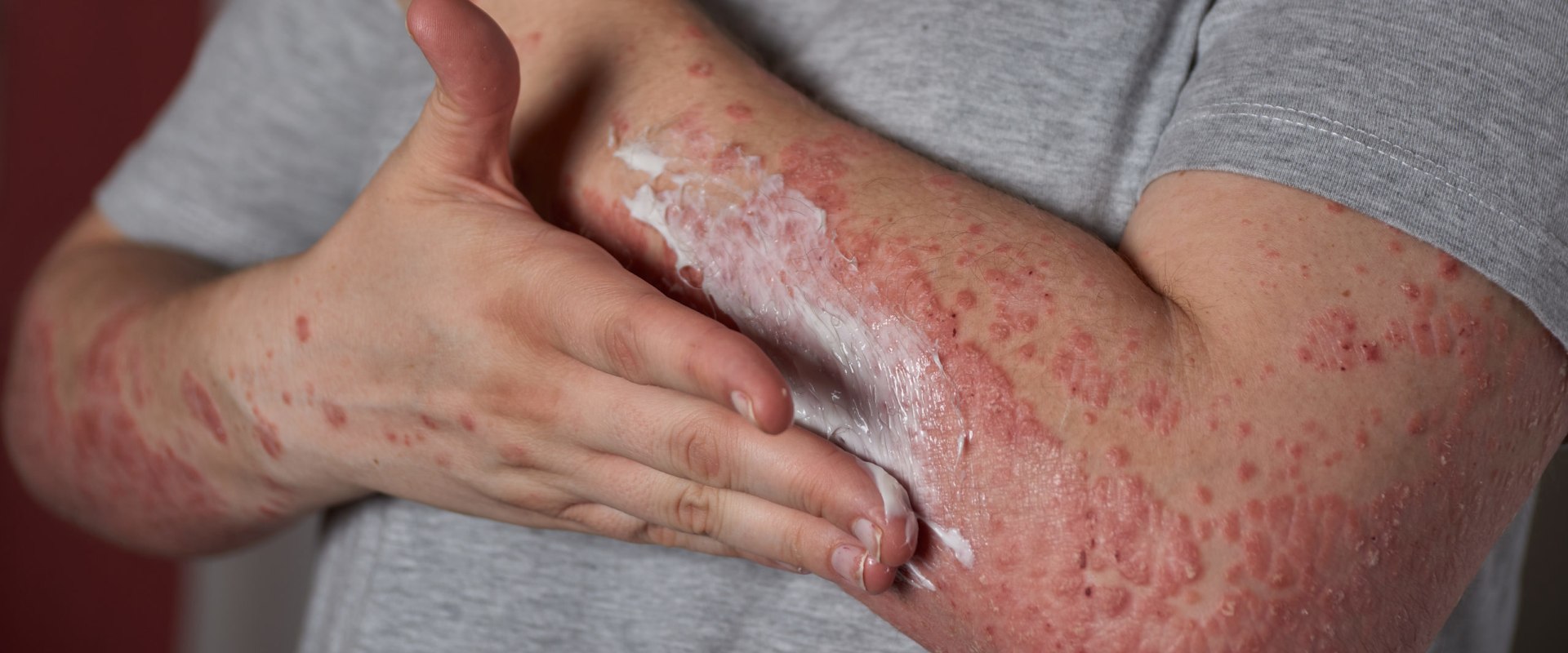 Weakened Immune System: Causes, Symptoms, and Treatments