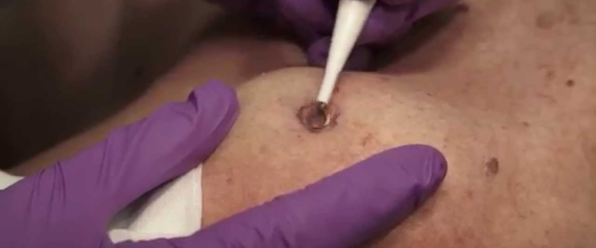 Everything You Need to Know About Electrocautery