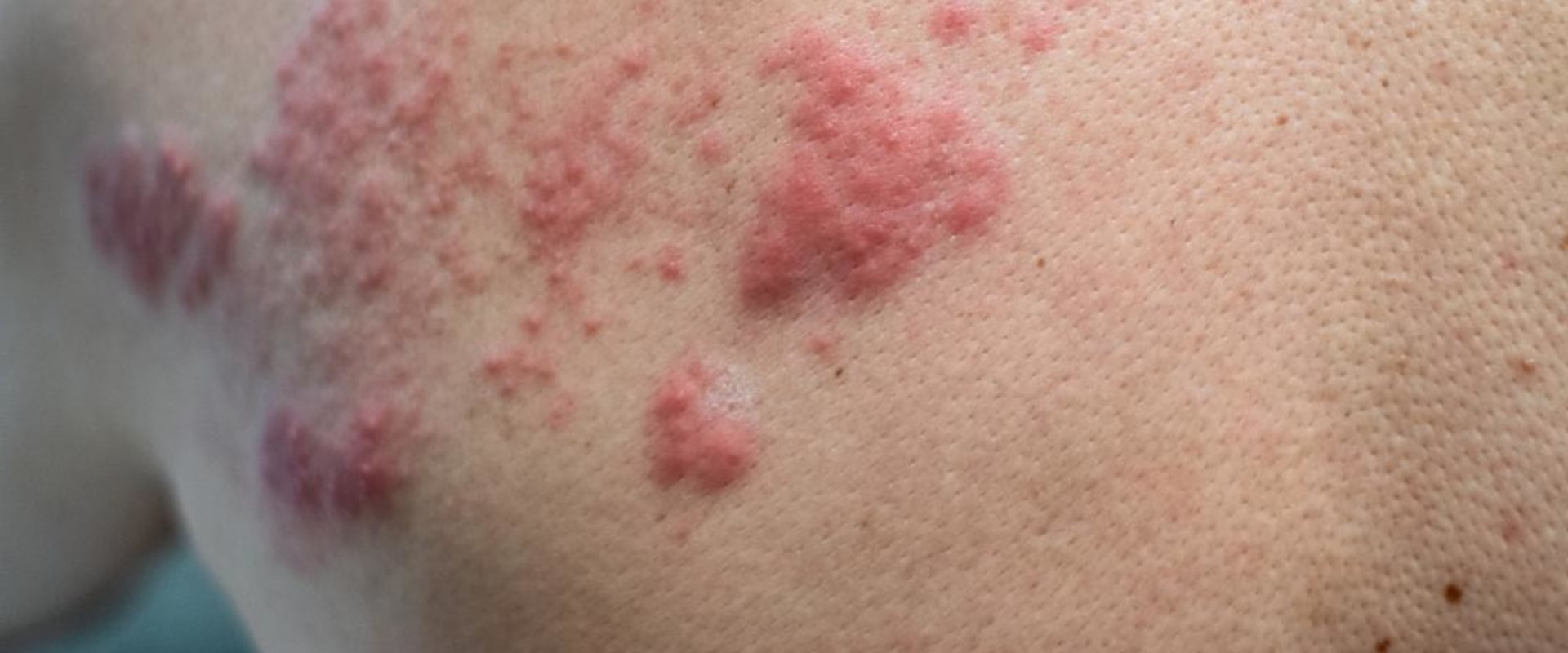 Itching and Burning: Common Symptoms