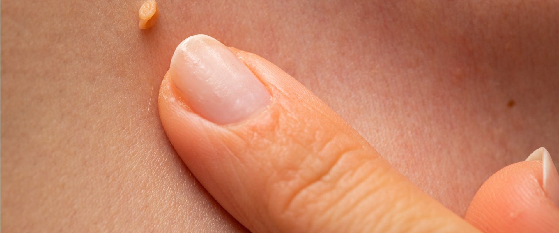 Preventing the Spread of Genital Warts Through Avoiding Sharing Personal Items