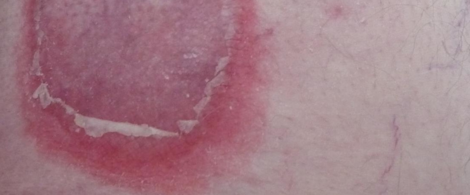 Blisters and Ulcers: Understanding Rare Symptoms