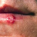 Herpes Simplex Virus (HSV): Everything You Need to Know
