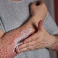 Weakened Immune System: Causes, Symptoms, and Treatments