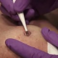Everything You Need to Know About Electrocautery