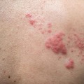 Itching and Burning: Common Symptoms