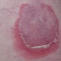 Blisters and Ulcers: Understanding Rare Symptoms