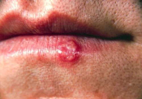 Herpes Simplex Virus (HSV): Everything You Need to Know