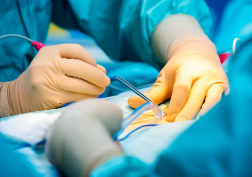 Understanding Electrocautery: Everything You Need to Know