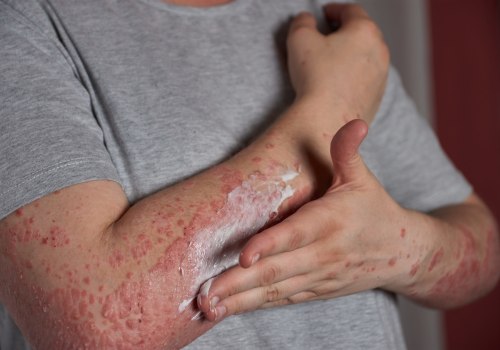 Weakened Immune System: Causes, Symptoms, and Treatments