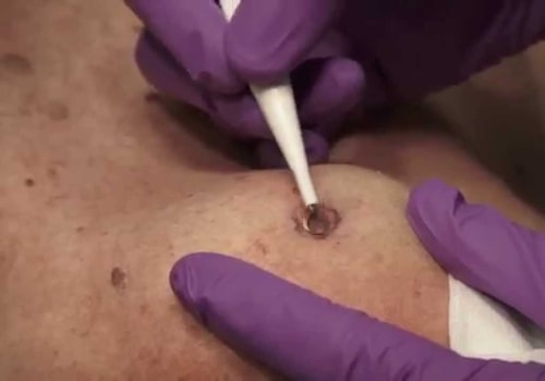 Everything You Need to Know About Electrocautery