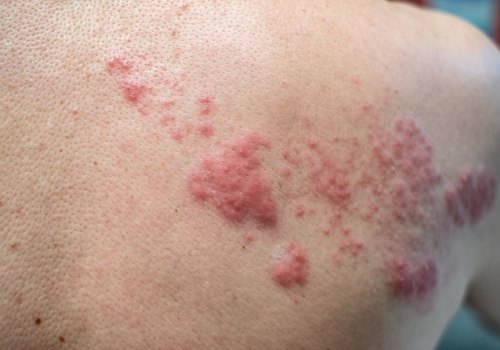 Itching and Burning: Common Symptoms