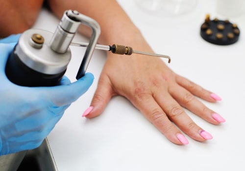 Cryotherapy: Exploring Medical Treatments for Genital Warts Removal
