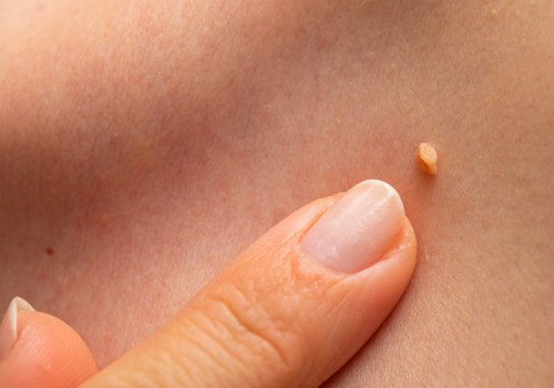 Preventing the Spread of Genital Warts Through Avoiding Sharing Personal Items