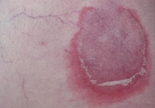 Blisters and Ulcers: Understanding Rare Symptoms